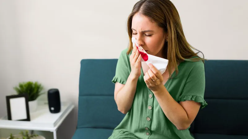 Woman holding a tissue with blood during a nosebleed, a possible symptom of acute blood cancer (acute leukemia)