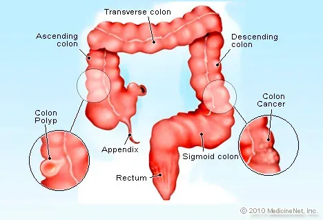 Diagram showing cecal cancer within the colon, highlighting the ascending colon, transverse colon, descending colon, sigmoid colon, appendix, and rectum.
