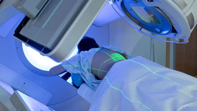 Stage 1 Colon Cancer Patient undergoing radiotherapy treatment with a medical linear accelerator, commonly used for colon cancer care