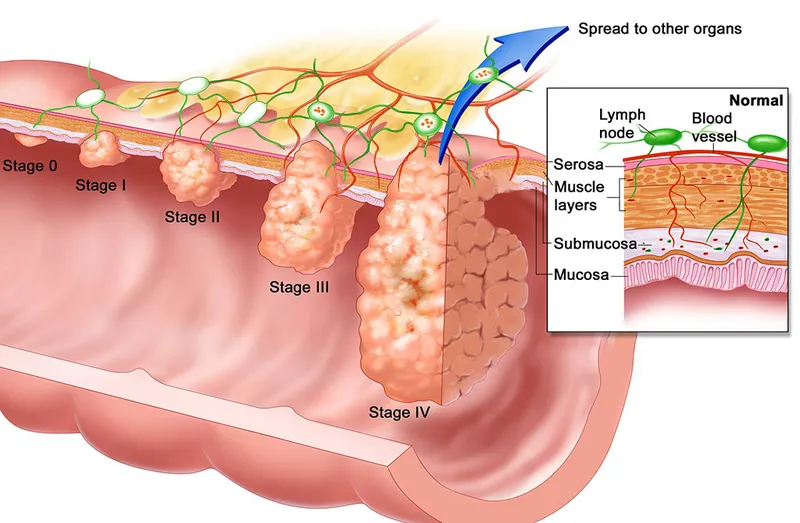 Illustration showing different stages of colon cancer and diagnostic evaluation