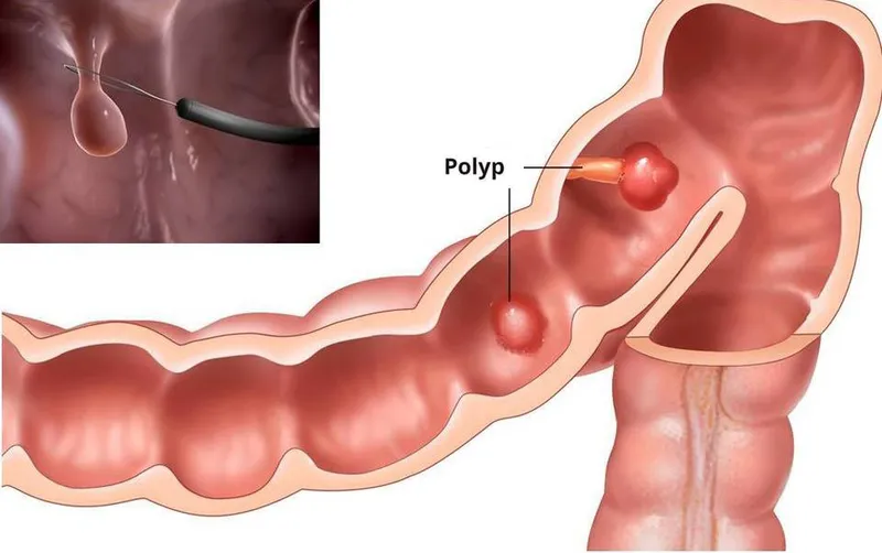 Colonoscopy showing polyps inside the colon for early detection and diagnosis