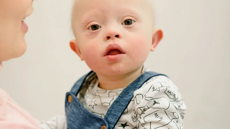 Child with Down syndrome, a genetic condition associated with increased risk of acute blood cancer (acute leukemia)