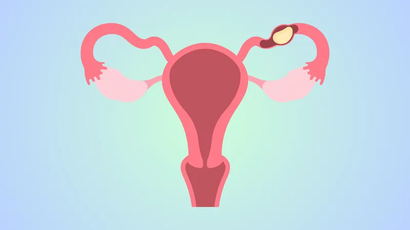 Illustration of ectopic pregnancy in the fallopian tube, which increases the risk of choriocarcinoma (placental cancer)