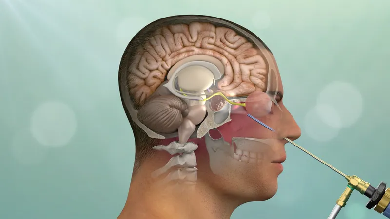 Pituitary Tumors Endoscopic transnasal surgery to remove a pituitary tumor