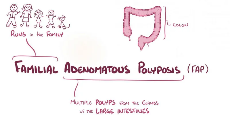 Stage 1 Colon Cancer Illustration explaining Familial Adenomatous Polyposis (FAP), a hereditary condition that causes multiple polyps in the large intestine and increases the risk of colon cancer