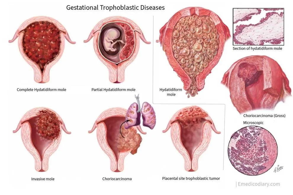 Illustration of gestational trophoblastic diseases including hydatidiform mole, invasive mole, choriocarcinoma, and placental site trophoblastic tumor