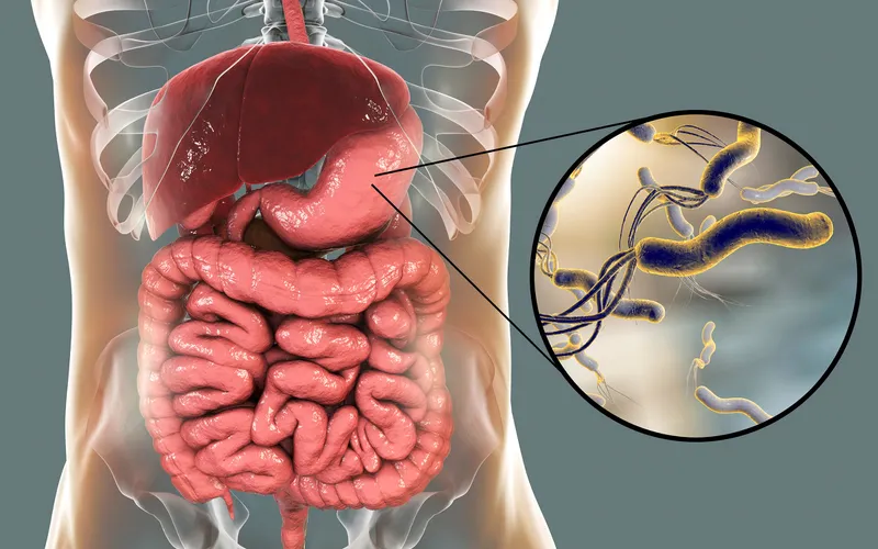 Illustration of the human digestive system with a close-up of Helicobacter pylori bacteria causing stomach ulcers and increasing gastric cancer risk