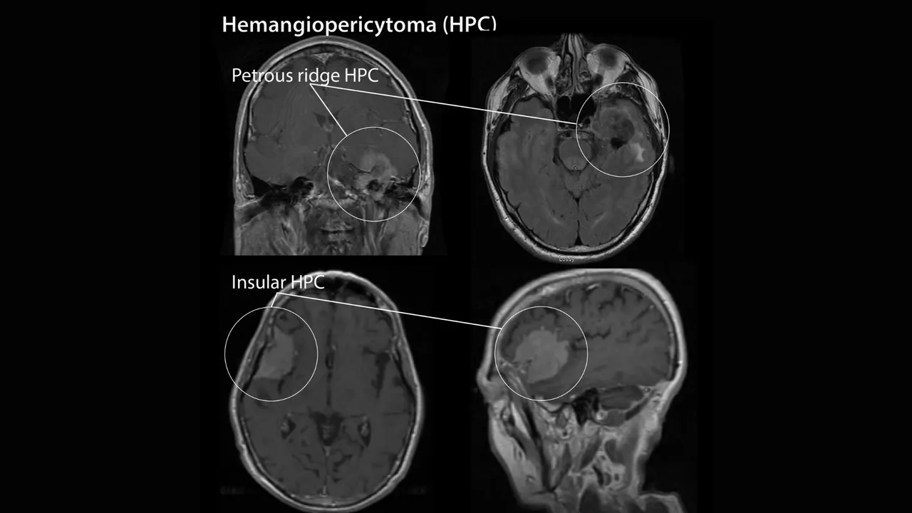 MRI scans showing hemangiopericytoma (HPC) in different brain regions including the petrous ridge and insular area