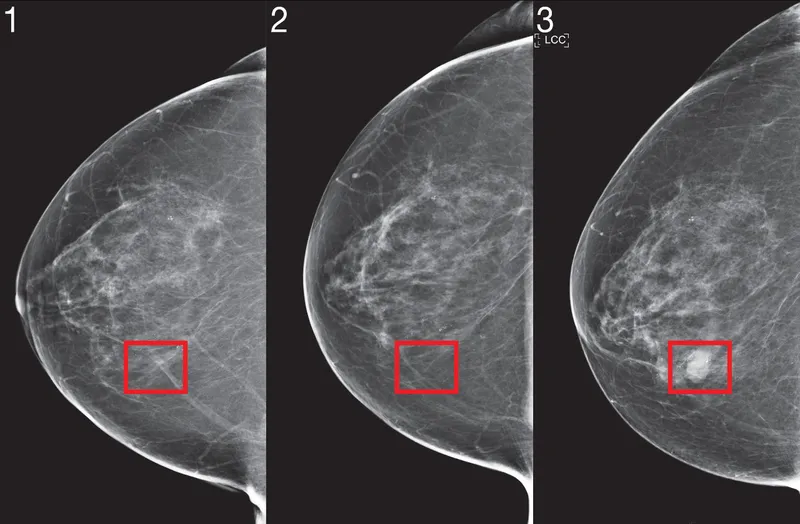 Series of mammogram images showing highlighted areas of potential breast cancer, with ultrasound often used as an alternative screening method for younger patients