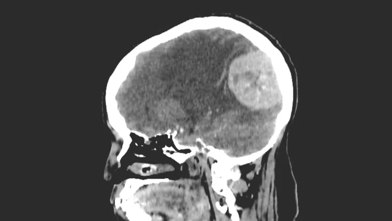 Brain scan showing a meningioma tumor