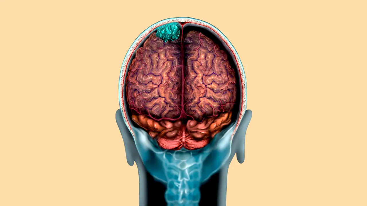 Illustration of a brain with meningioma tumor on the meninges