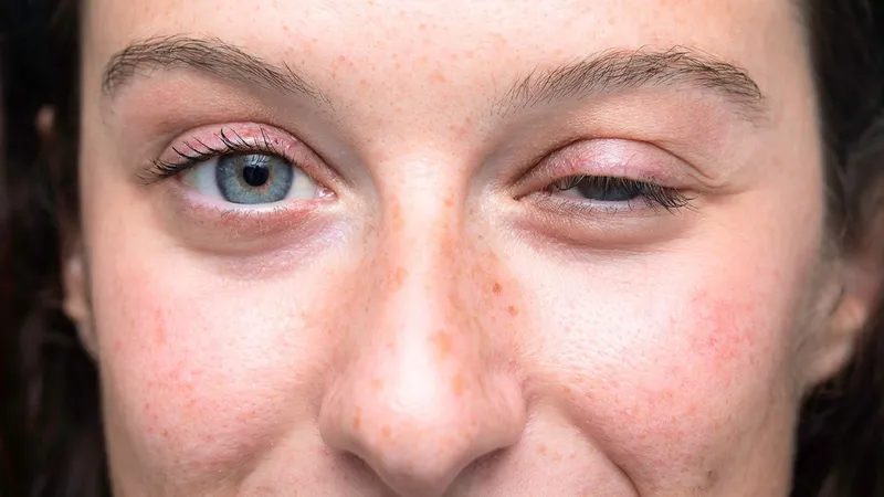 Close-up of a woman with one drooping eyelid, a common symptom of myasthenia gravis