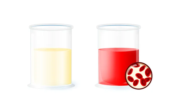 Urothelial Carcinoma Illustration comparing normal urine and urine with blood (hematuria) in laboratory containers, highlighting the presence of red blood cells.