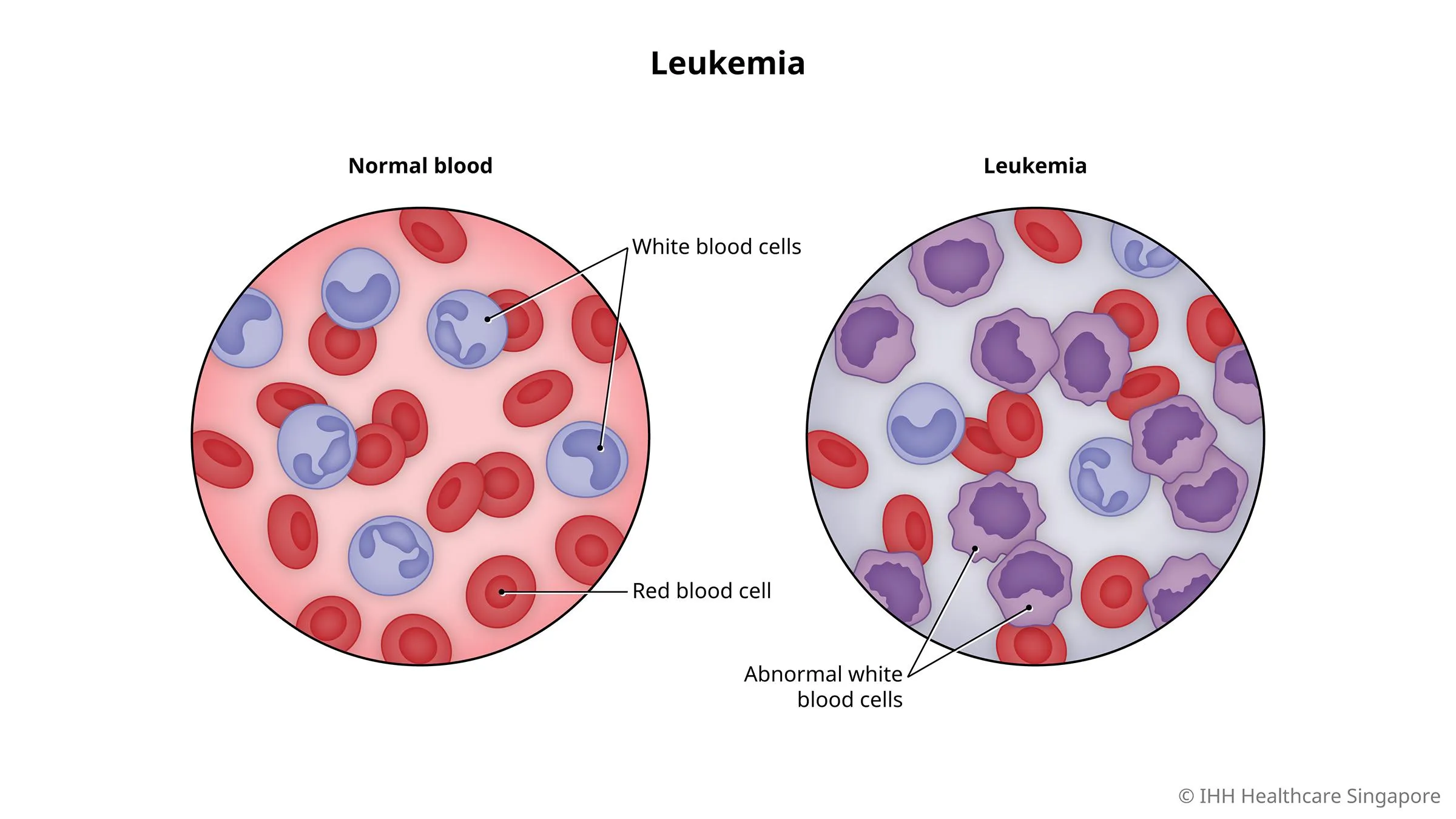 Comparison of normal blood and leukemia blood showing red blood cells, white blood cells, and abnormal white blood cells