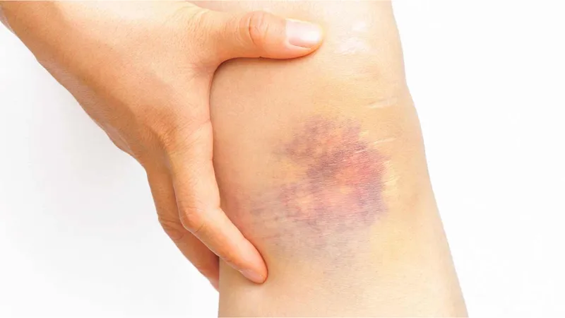 Angiosarcoma Close-up of a leg with a persistent bruise, highlighting a possible sign of angiosarcoma or another serious condition
