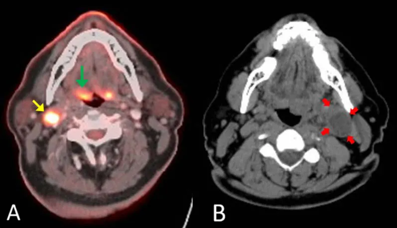 Pharyngeal Cancer PET-CT scan showing detailed imaging of a pharyngeal tumor for cancer diagnosis.