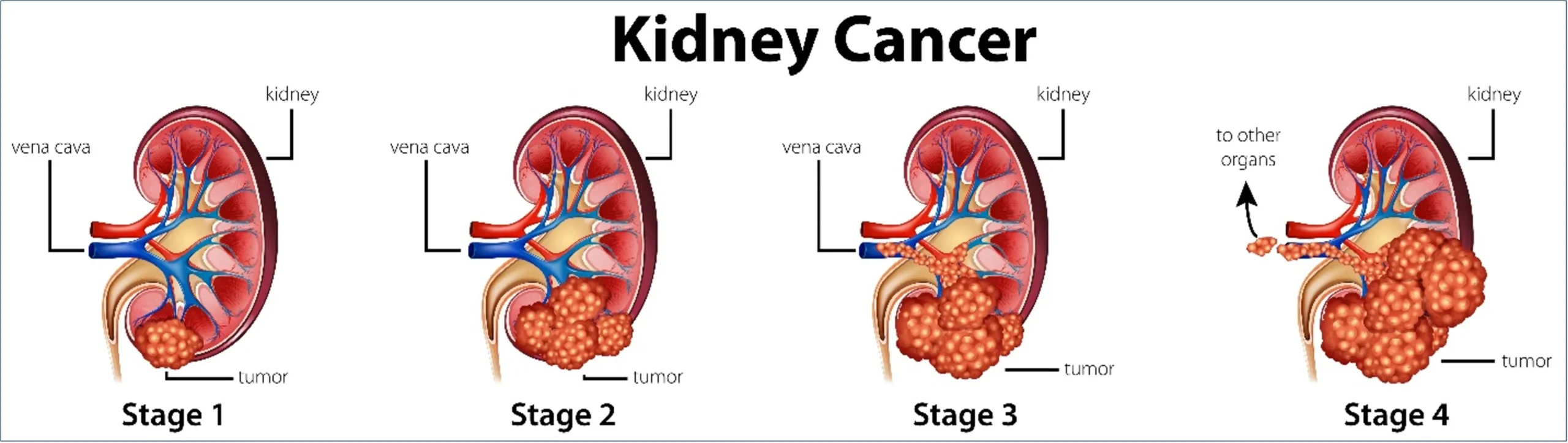 Diagram showing the stages of renal cell carcinoma (kidney cancer) from stage 1 to stage 4