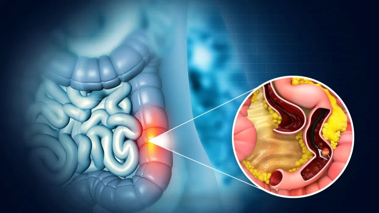 Illustration showing signet ring cell carcinoma in the colon with a detailed cross-section of the affected area