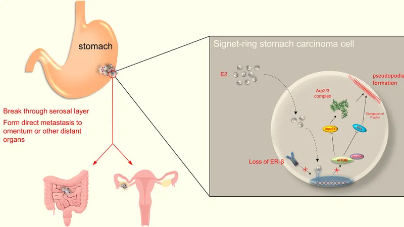 Diagram showing how signet ring cell carcinoma of the stomach can metastasize to the ovaries and intestine