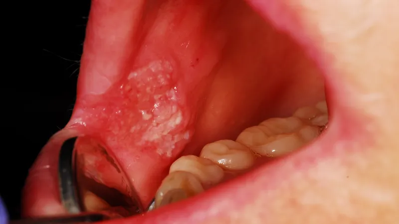 Squamous Cell Carcinoma Squamous cell carcinoma lesion on the oral mucosa showing white patchy tissue changes inside the mouth.