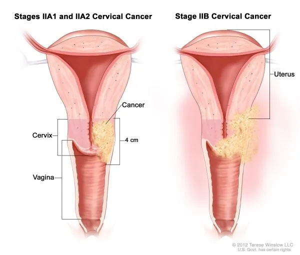 Medical illustration showing Stage 2 uterine cancer and its spread within the uterus and cervix