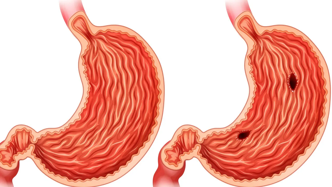 Medical illustration showing stage 3 stomach cancer with visible lesions in the stomach lining