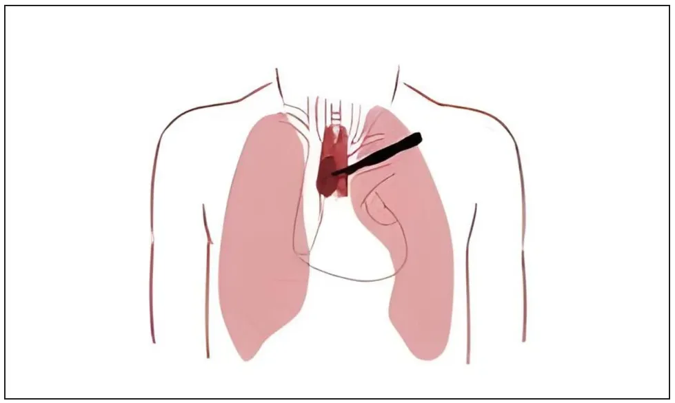 Illustration showing the location of the thymus gland in the chest, where thymoma can develop