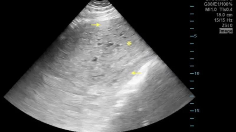 Ultrasound image showing a hydatidiform mole (molar pregnancy), a precursor to choriocarcinoma