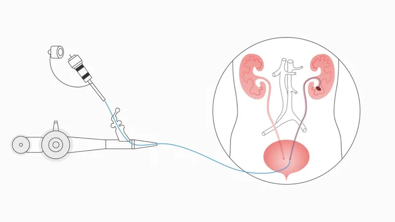 Urothelial Carcinoma Illustration of ureteroscopy showing an endoscopic procedure used to examine and treat conditions in the ureter and urinary tract.
