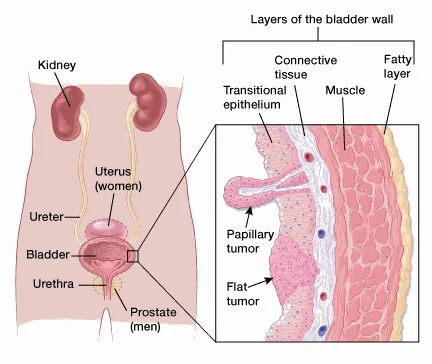 Urothelial Carcinoma Medical illustration showing the urinary tract with kidneys, ureters, bladder, and urethra, and a cross-section of the bladder wall layers with papillary and flat tumors.