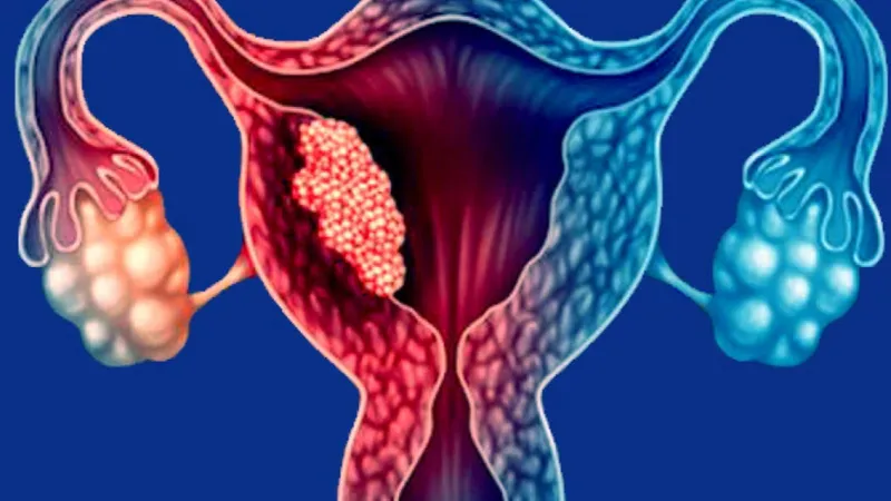 Medical illustration showing a tumor inside the uterus highlighting unknown causes of uterine cancer