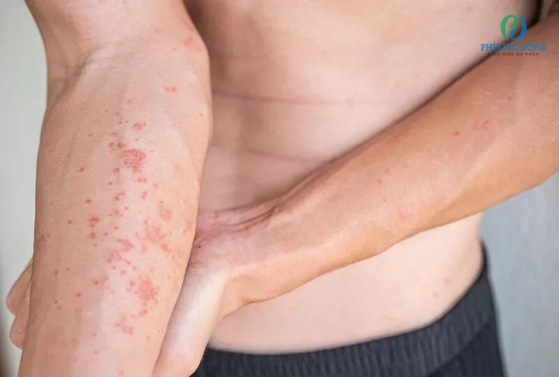Red itchy rash caused by allergic dermatitis on the forearm