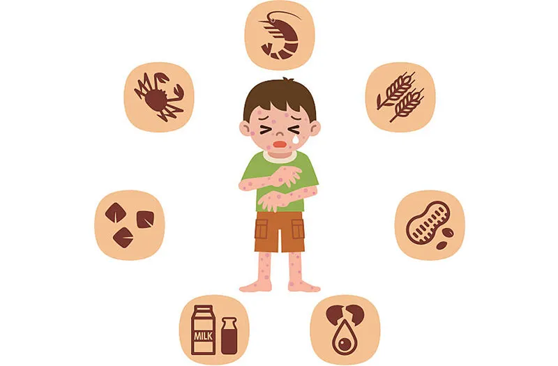 Anaphylaxis Illustration of common anaphylaxis triggers such as shellfish, peanuts, milk, eggs, and wheat causing allergic reactions in children.