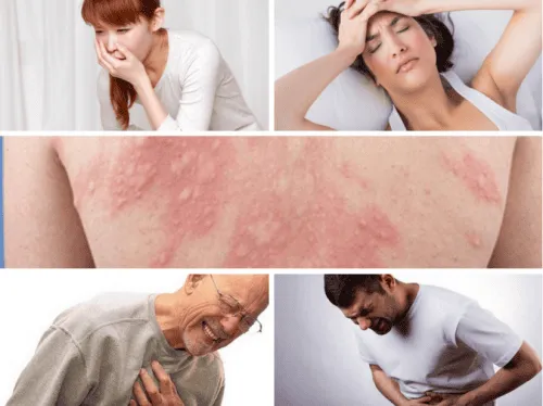 Anaphylaxis Common symptoms of anaphylaxis including rash, nausea, headache, chest pain, and abdominal cramps.