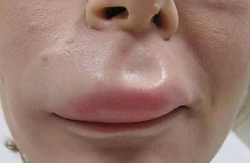 Severe lip swelling caused by angioedema, showing inflammation and tissue fluid buildup.
