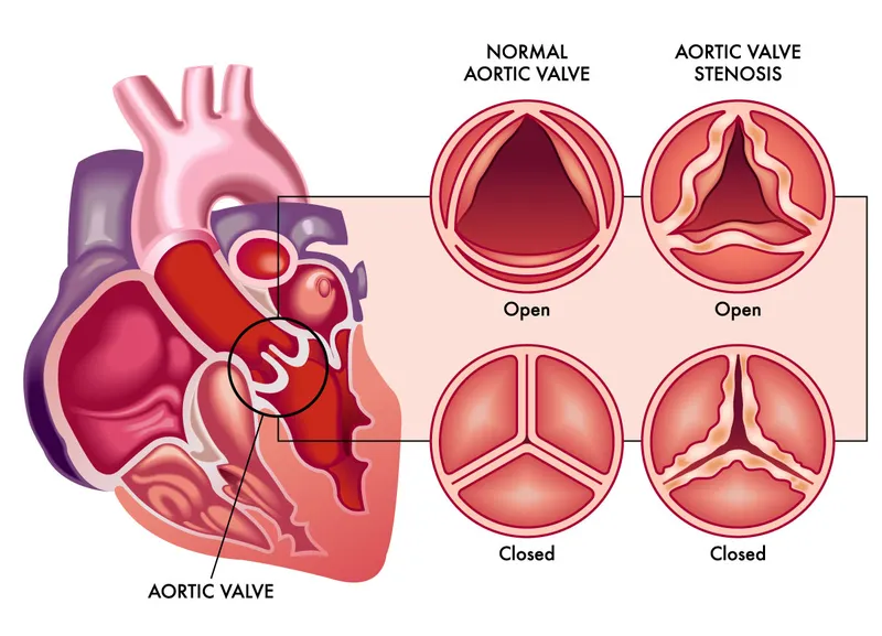 diagram comparing normal aortic valve and aortic valve stenosis showing open and closed valve positions