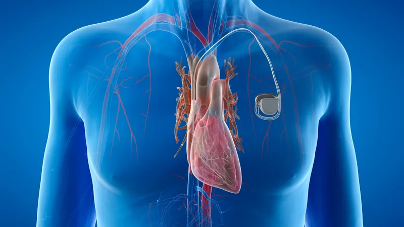 3D illustration showing a human heart with a pacemaker, representing arrhythmia and irregular heartbeat.