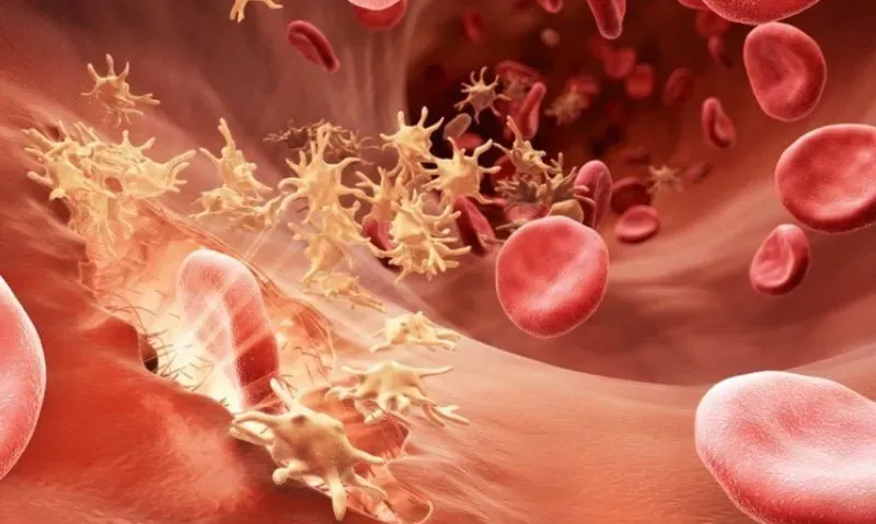 Illustration showing abnormal blood clot formation in blood vessels