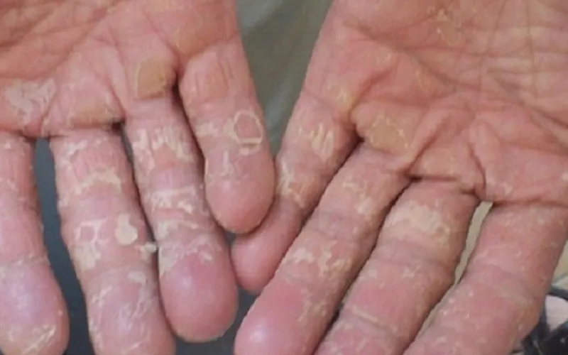 Peeling and irritated skin on the hands caused by chemical contact dermatitis.