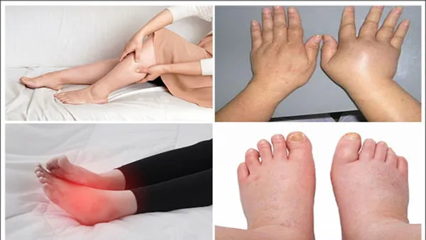 Edema in legs and feet treated with Chlorthalidone diuretic