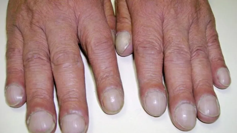 clubbed fingers symptom associated with chronic mitral valve regurgitation