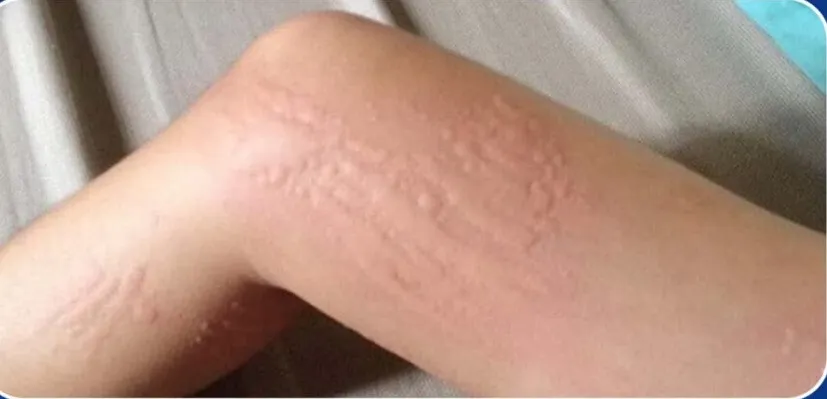 Skin hives caused by cold exposure on the leg