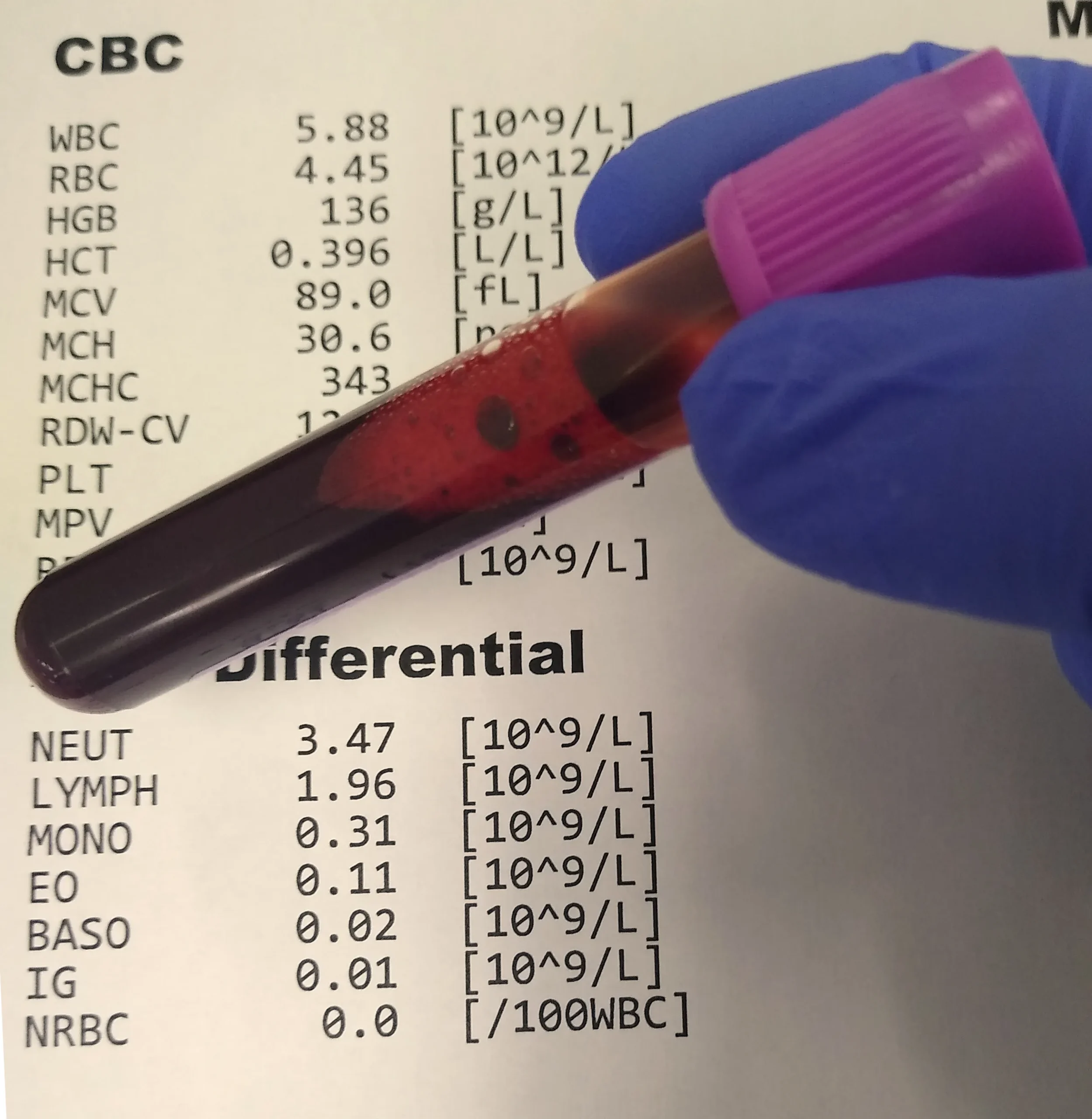 CBC blood test sample and printed lab report showing differential results