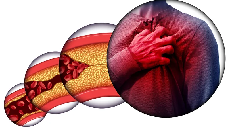 Coronary artery disease as a serious complication of atherosclerosis