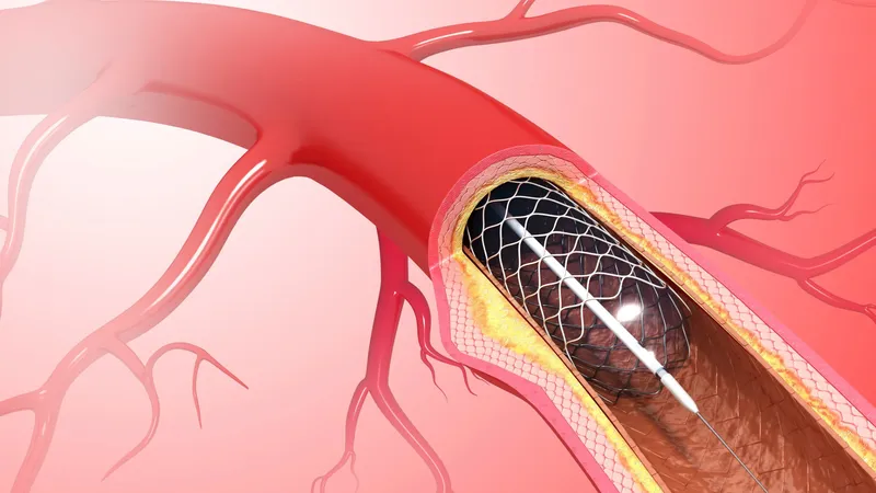 Coronary stent placement improves blood flow in narrowed arteries caused by atherosclerosis
