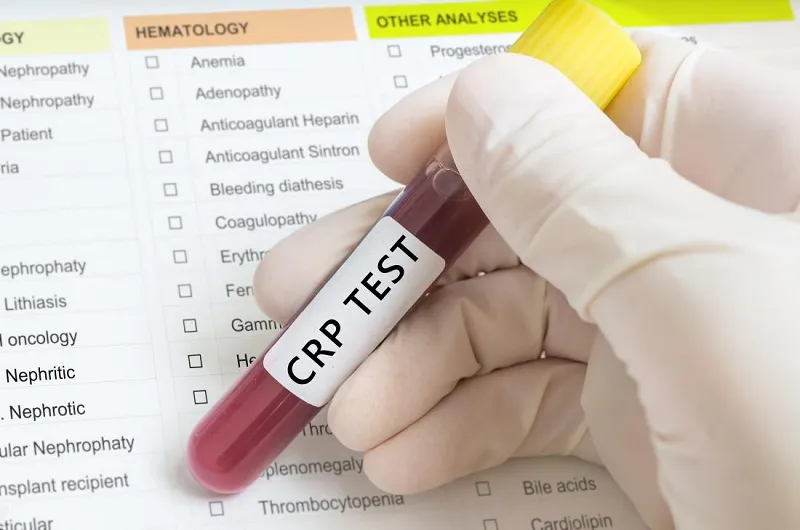 Blood sample labeled "CRP Test" used for measuring C-reactive protein levels.