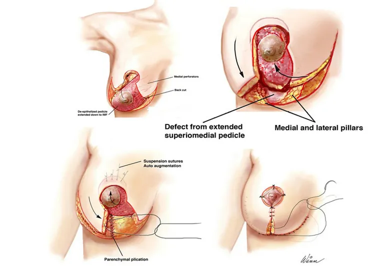 Medical illustration showing surgical procedure for ductal carcinoma in situ (DCIS) of the breast, including tissue removal and reconstruction steps