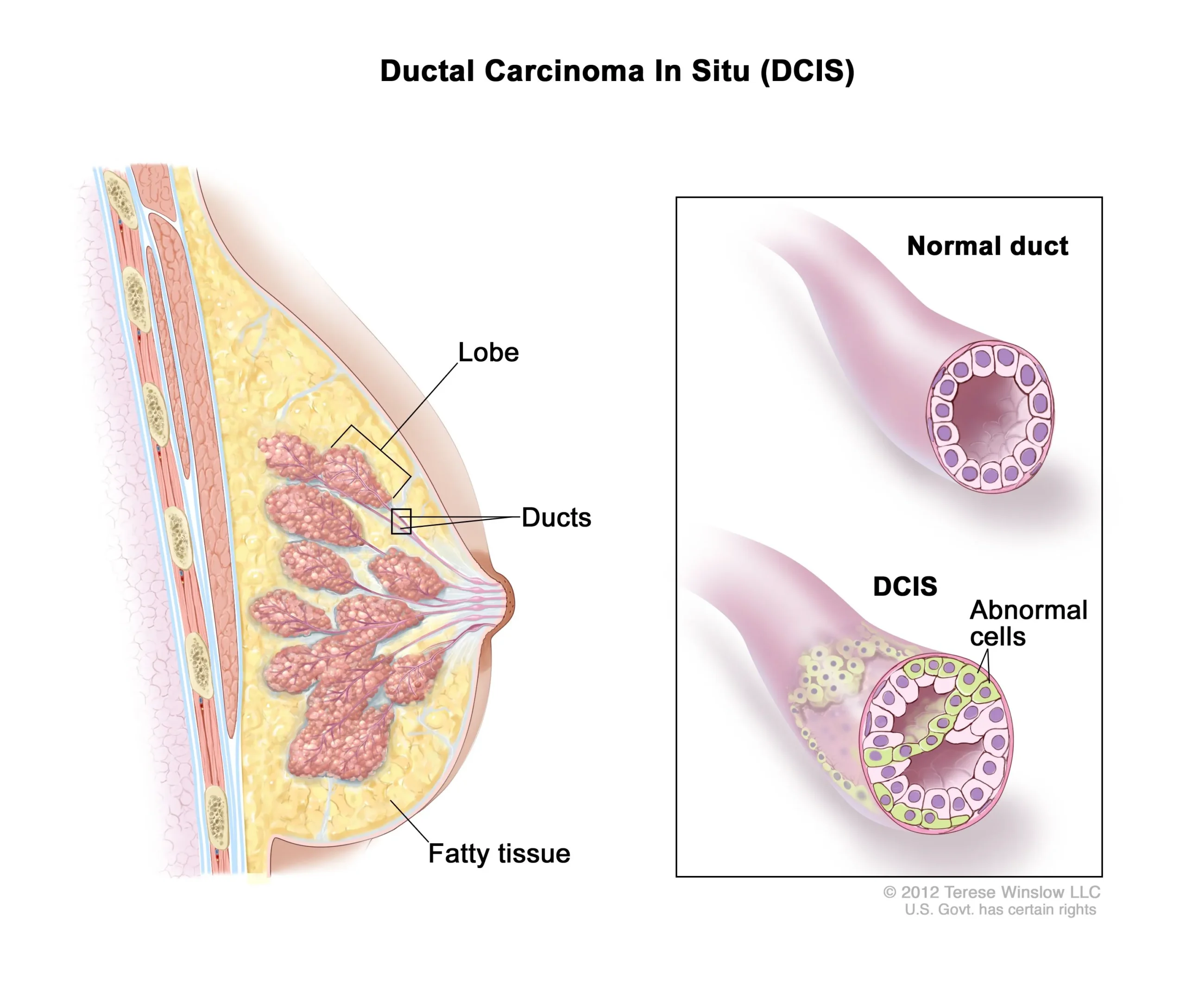 Diagram showing ductal carcinoma in situ (DCIS) with abnormal cells inside the milk duct.