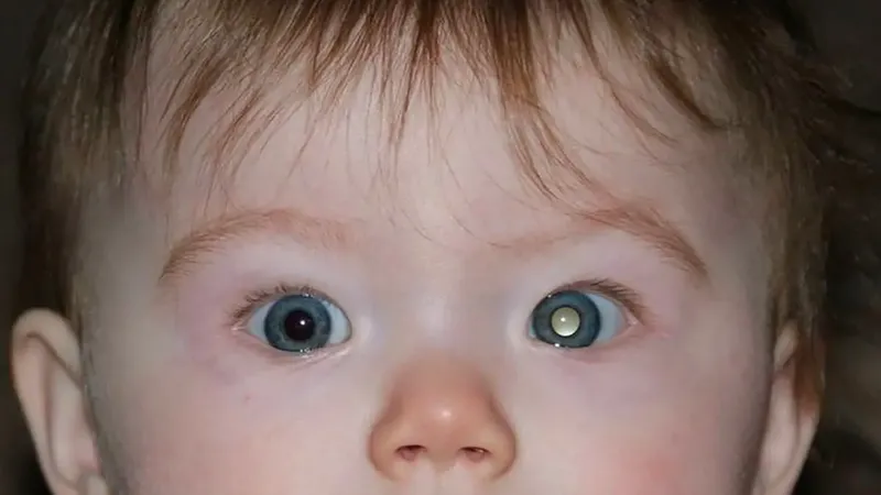 Early symptom of retinoblastoma showing a white or pale pupil in a child