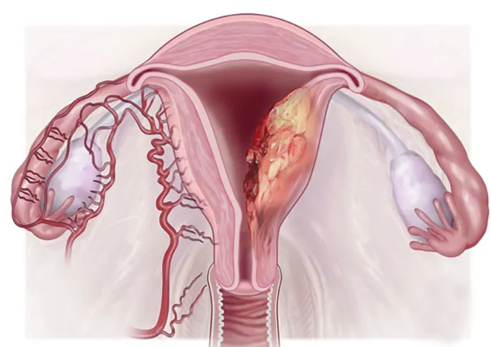 Medical illustration showing endometrial cancer inside the uterus with abnormal tissue growth